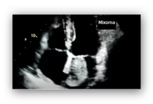 cardiac myxoma