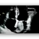 cardiac myxoma