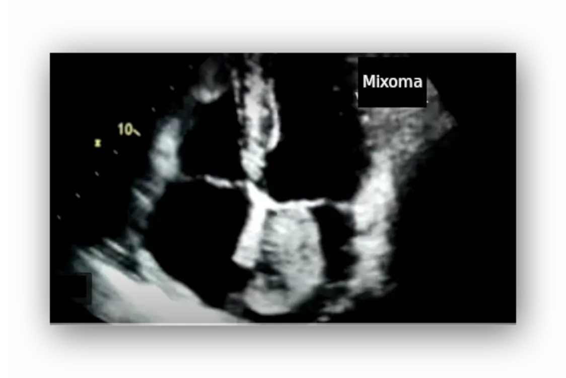 cardiac myxoma