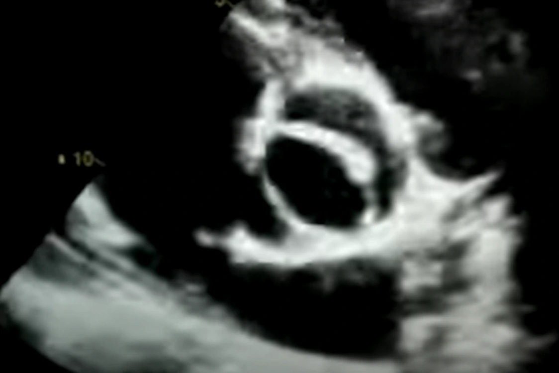 bicuspid aortic valve