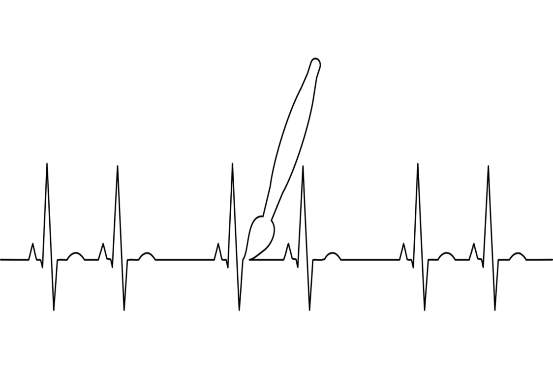 sinus arrhythmia