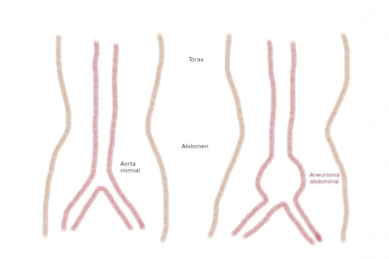 Aneurismas de aorta abdominal - Web del Corazón